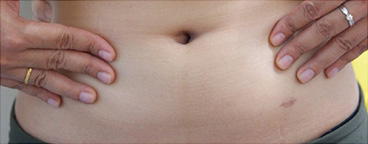Laparoscopic Surgery Scar